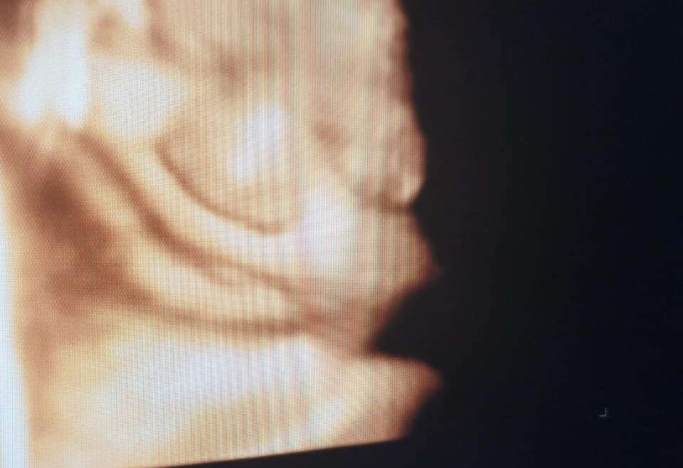 3D/4D ultrazvučna dijagnostika