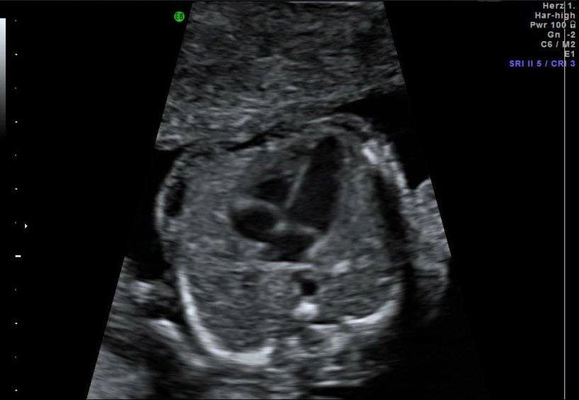 Fetalna ehokardiografija